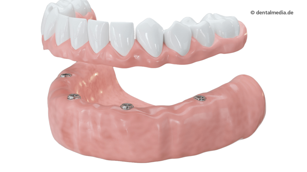 Zahnprothesen in Hamm | Praxis Alsibai